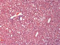 Male mice liver - steatosis
